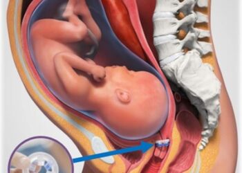 Confronting the Preterm Birth Crisis: A New Hope on the Horizon