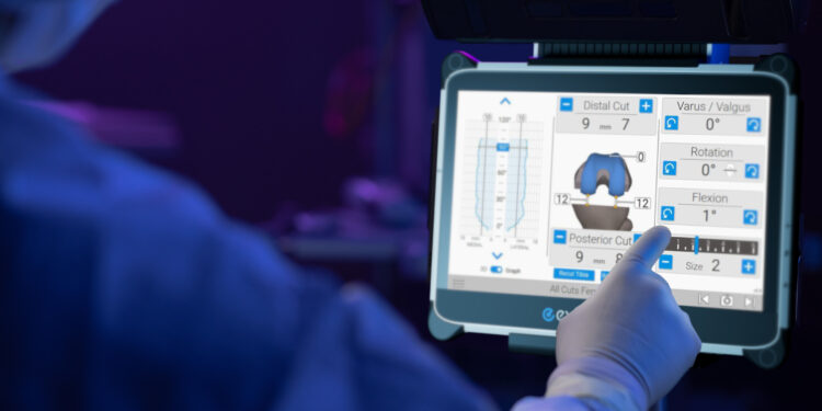 Exactech Introduces New Balancing Technology for Knee Replacement Patients
